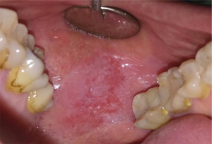 lichen planus mouth lesions