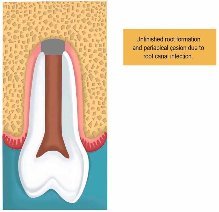 Mechanisms Involved in Apice Closure of Pulpless Teeth