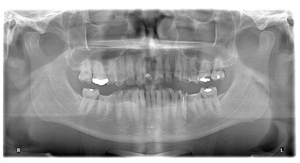 The Restoration of Severe Generalized Dental Erosive Wear using