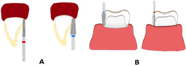 Vertical Teeth Preparation: A Comprehensive Systematic Review of Patient Outcomes and Clinical Complications