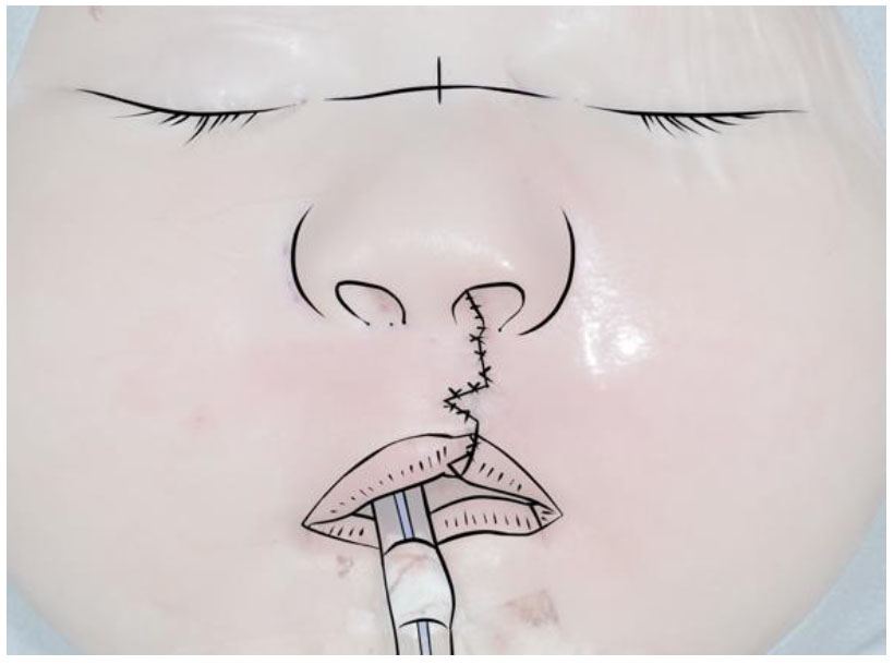 Nasolabial Appearance Evaluation by Surgeons and Inexperienced Health Workers after Primary Unilateral Cleft Lip Repair Using the Cronin Technique