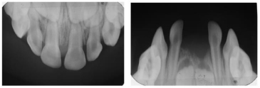 Odontohypophosphatasia Diagnosed through Isolated Dental Findings: A Longitudinal Case Report
