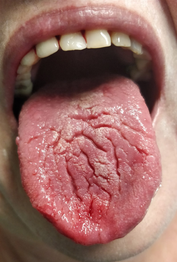 The Effect of Infection SARS-COV-2 on the Condition of the Salivary Glands – A Retrospective Study