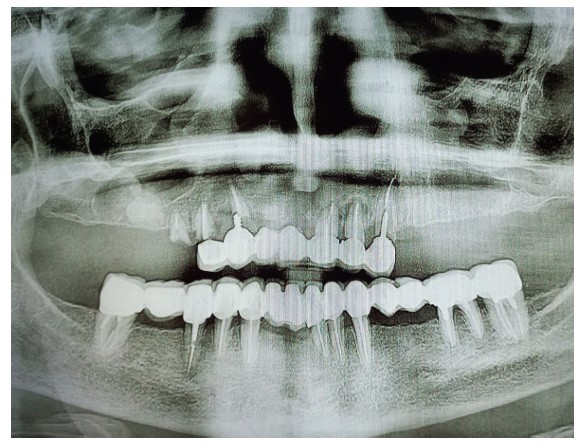 Dental Implants and Idiopathic Osteosclerosis: Two Case Reports