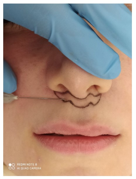 Modified Upper Lip Lift Technique: A Clinical Study to Evaluate Esthetic, Functional, and Scar Quality