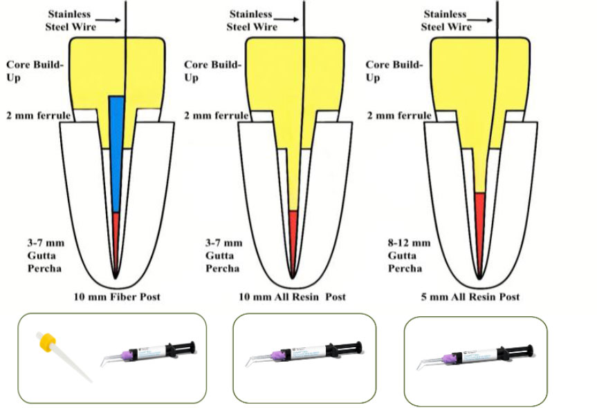 Bond Strength and Failure Modes of Fiber  Resin-based Posts with Different Lengths in Endodontically Treated Premolars: An  Study