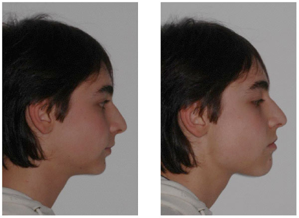 a to d This patient's Class II Division 2 malocclusion was