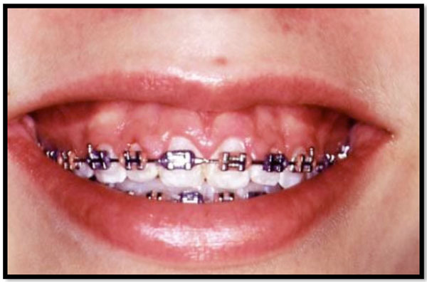 Columbia PA Orthodontist, Elastics For Braces